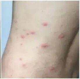水痘 接种 疫苗 脑炎 结痂 红疹